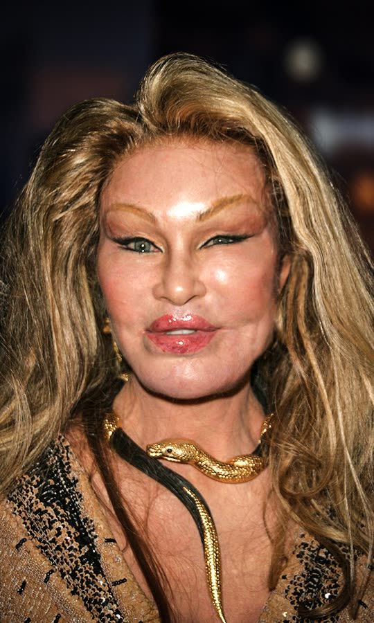 How Much Botox Is Too Much?