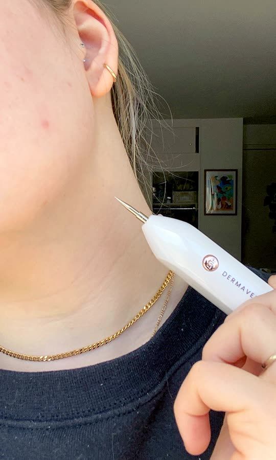 Pen Removes Skin Tags