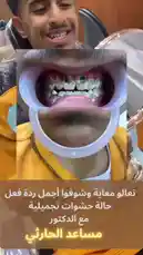 Witness a dramatic smile transformation in this real-life case study from Al-Sadah Medical Complex. A young man shares his journey from misaligned teeth to a confident, beautiful smile through orthodontic treatment. This video showcases the power of modern dental care and invites you to see your own potential. by @saudi_medicalce with saudi_medicalce by Original Sound