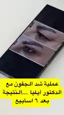 A close-up look at a smartphone screen displaying a side-by-side comparison of a client's eyebrow transformation at Bella Clinic. The 'before' image shows sparse, uneven brows, while the 'after' image reveals a perfectly shaped, defined, and fuller set of eyebrows, showcasing the clinic's expertise in cosmetic enhancements. by @bellaclinickw with Original Sound by bellaclinickw