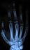 Se faire craquer les doigts provoque de l'arthrose ?