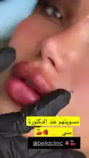 This close-up footage provides a detailed look at a professional lip enhancement procedure being performed by Bella Clinic. An aesthetician wearing black gloves carefully manipulates the patient's lips, which appear plump and slightly pink, showcasing the immediate results of the treatment. The clinic's branding is visible on-screen throughout the clip. by @bellaclinickw with ♡ ♡ ♡ ♡  ♡ by smn