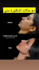 في هذا المقطع، تعرض د. منى شاهين نتائج مذهلة لعمليات التجميل التي أجرتها على مريضاتها. يعرض الفيديو صورًا مقارنة "قبل وبعد" لتوضيح التغييرات الجمالية الدقيقة. يركز المحتوى على الوجه والأنف، ويقدم مثالًا عمليًا على المهارات الطبية للدكتورة منى شاهين في مجال التجميل. by @bellaclinickw with original sound