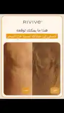 Discover the real Rivive difference. This side-by-side comparison shows visible skin improvement, highlighting texture and tone changes. See how Rivive delivers results you can see. by @rivive.sa with original sound