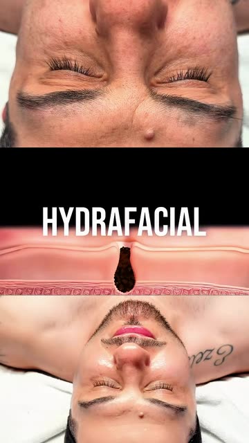 ghk cu with accutane Post-Accutane Scars and Texture: Can Copper Actually Help Skin Remodeling? is ghk cu better than
