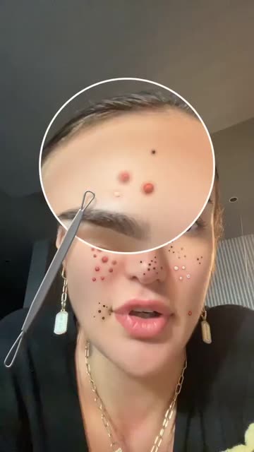 Preview for a Spotlight video that uses the Acne Removal Lens