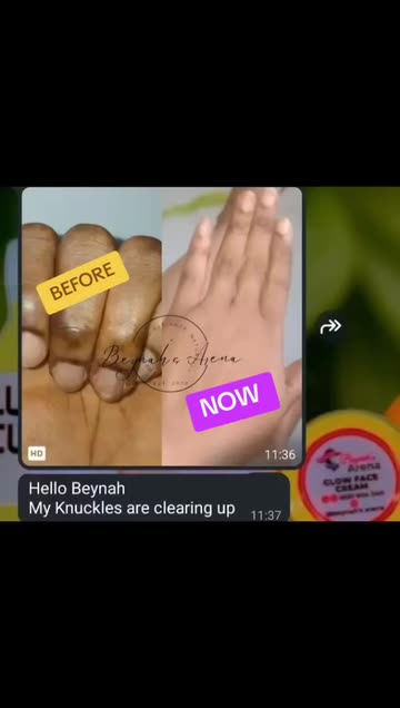 glutathione for dark knuckles High Quality Brightening Whitening Serum & Elbows Liquid Skincare with Even Skin Tone Skincare glutathione for dark knuckles This
